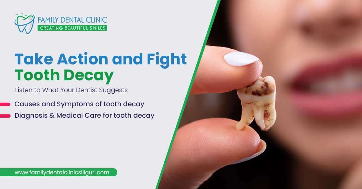 Take Action And Fight Tooth Decay- Consult Best Dental Clinic in Siliguri
