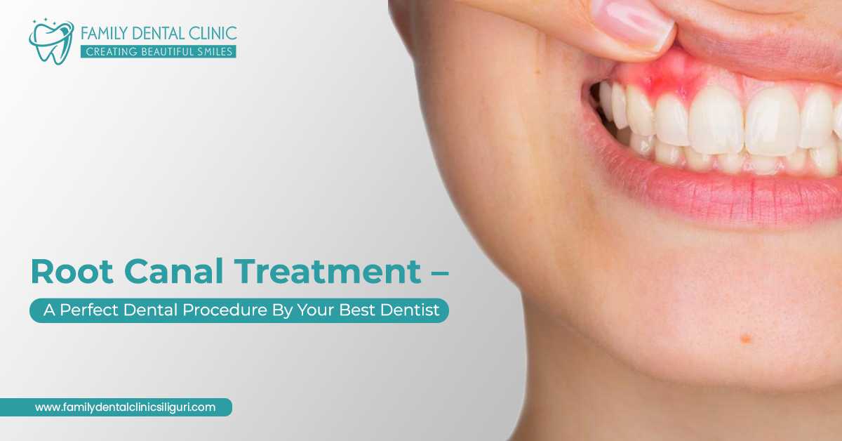Root Canal Treatment – A Perfect Dental Procedure By Your Best Dentist