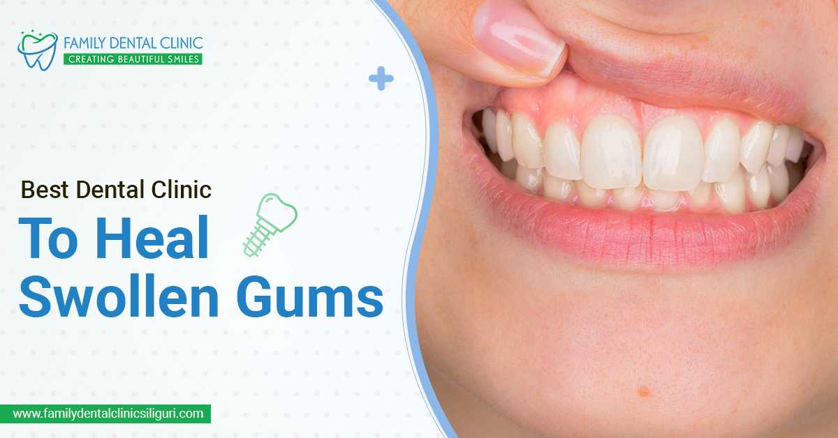 Best Dental Clinic To Heal Swollen Gums